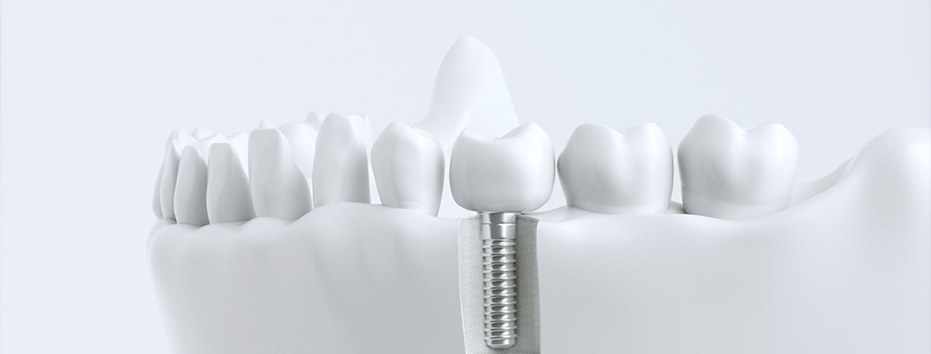 Zahnimplantate in Hannover – Ihr Zahnarzt Sven Krain